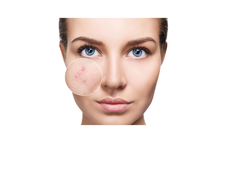 Acne Treatment Laser Therapy