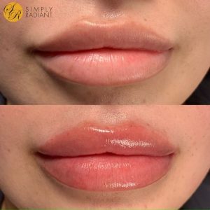 Lip Fillers Before & After