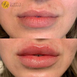 Lip Fillers Before & After