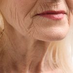 Las Vegas Neck Wrinkle Treatment